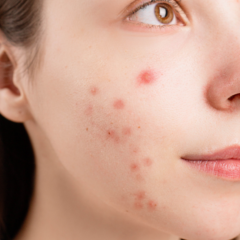 De beste natuurlijke ingrediënten tegen acne en puistjes